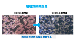 高圧水素酸素治療(HBHOT)による血液の変化（暗視野顕微鏡で撮影）岡崎ゆうあいクリニック